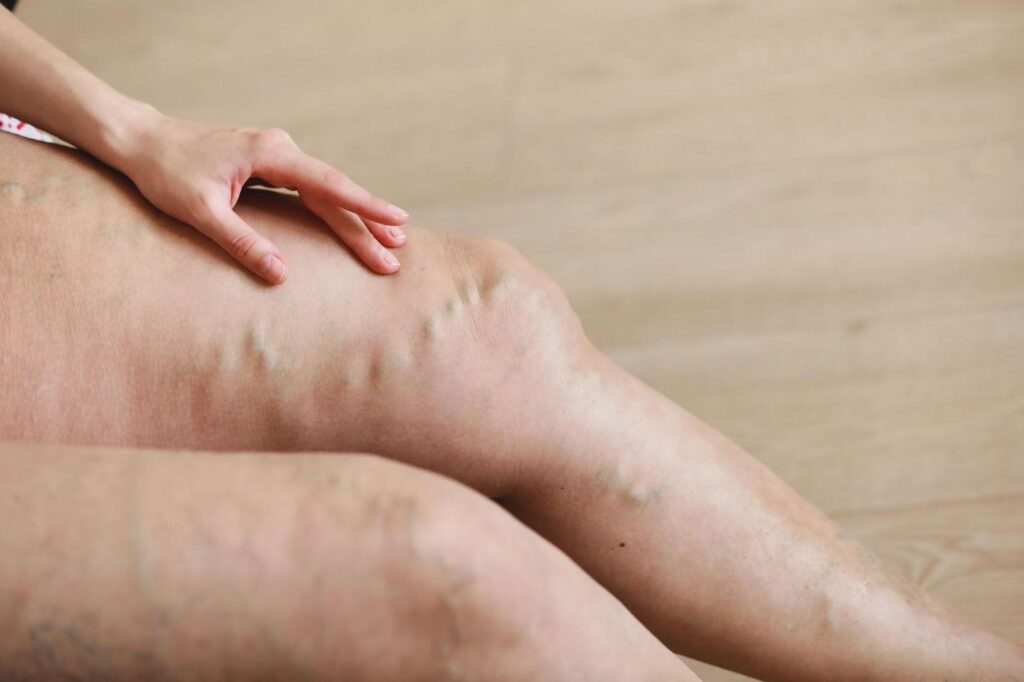 Varicose veins on a woman’s legs.