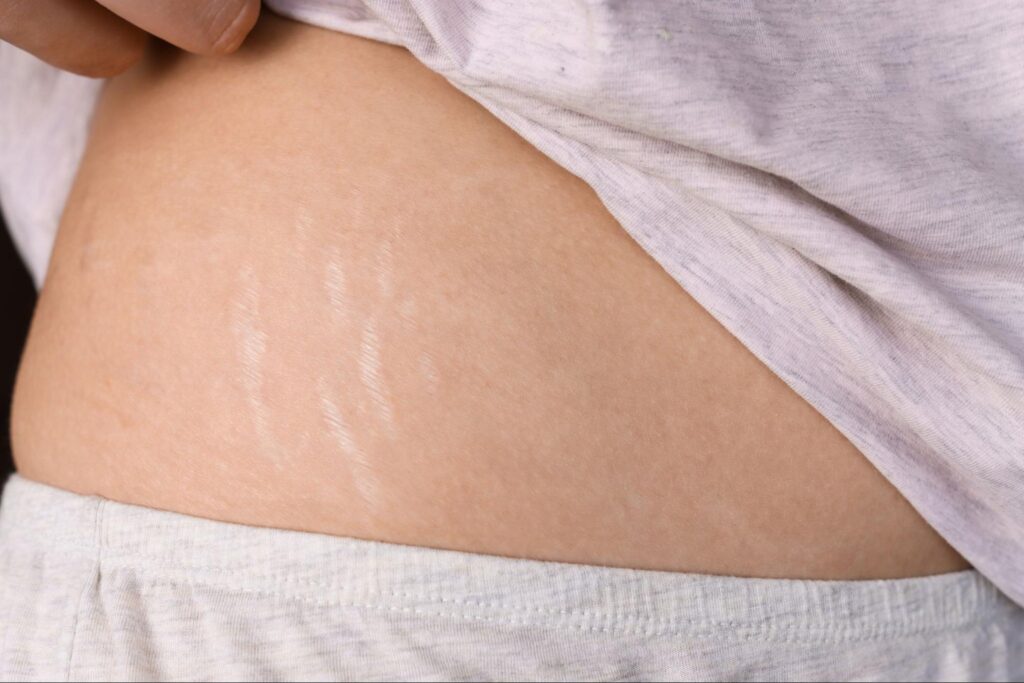 Woman lifting up her shirt to reveal stretch marks.