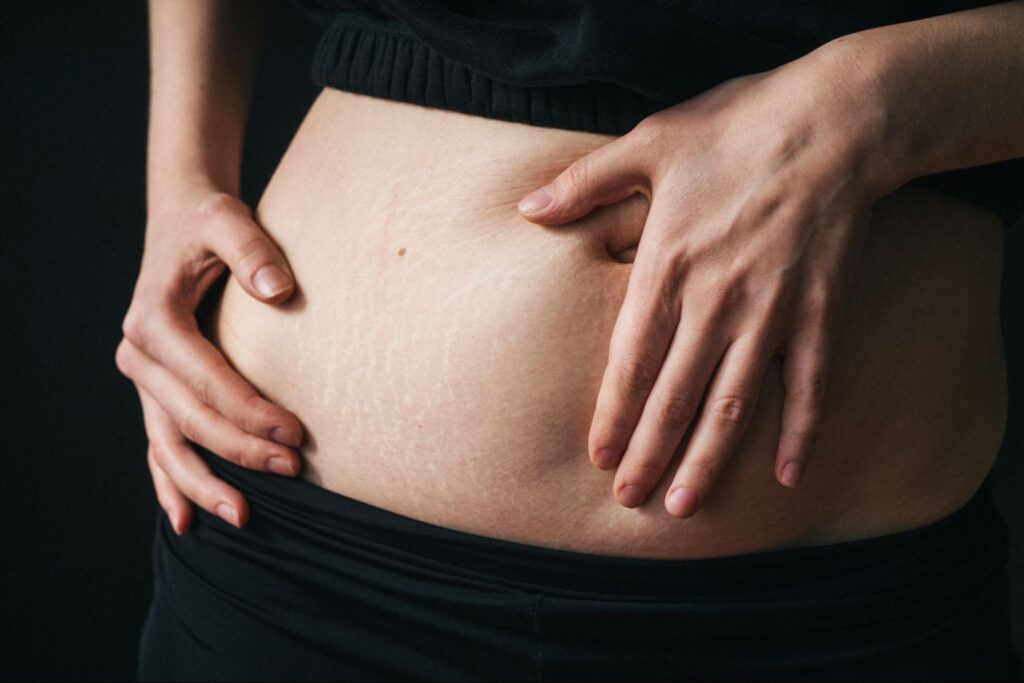 Woman with stretch marks on her stomach.