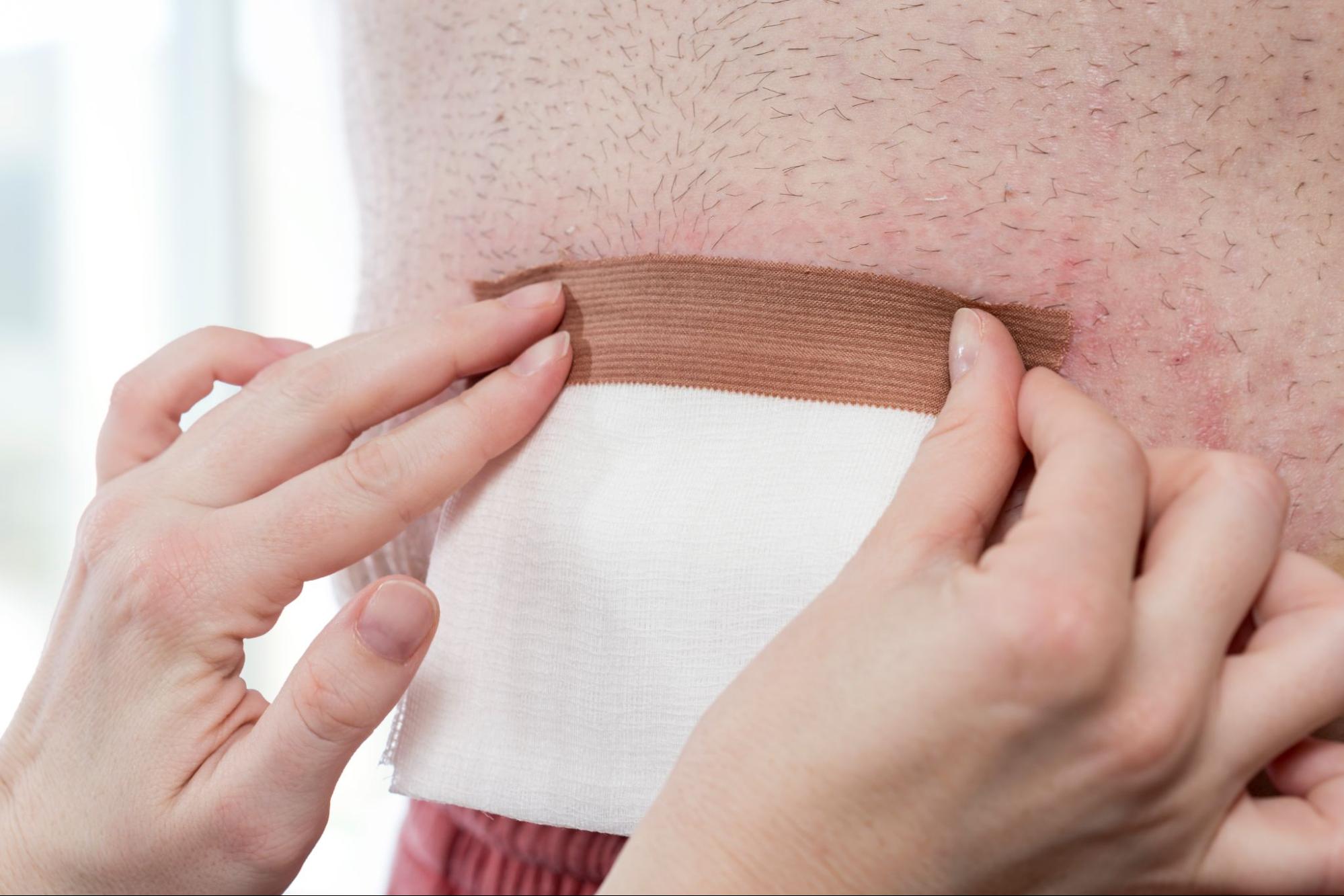 A nurse applying dressing to a patient’s hip.