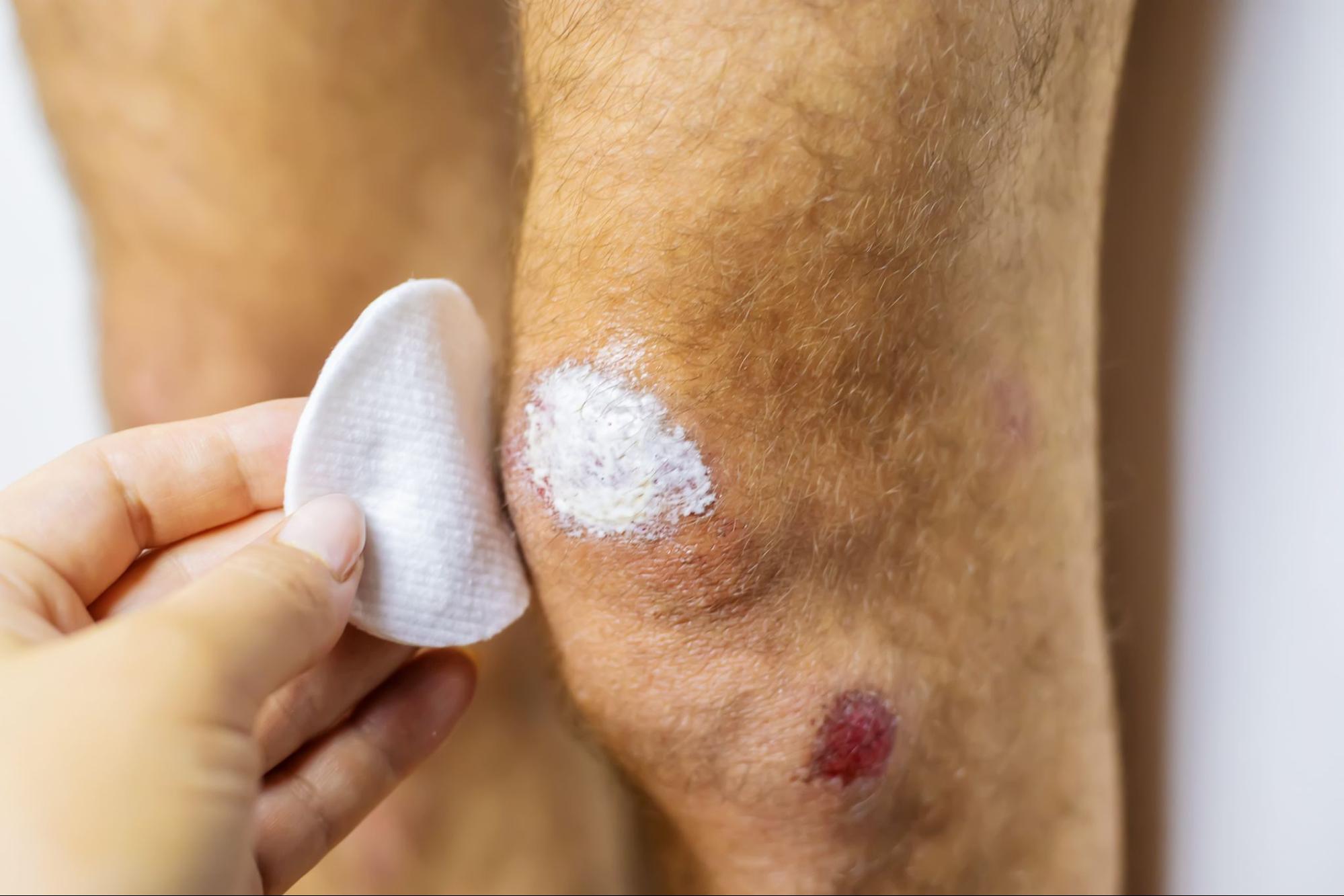 A doctor using medicine to treat a wound on a man’s knee. 