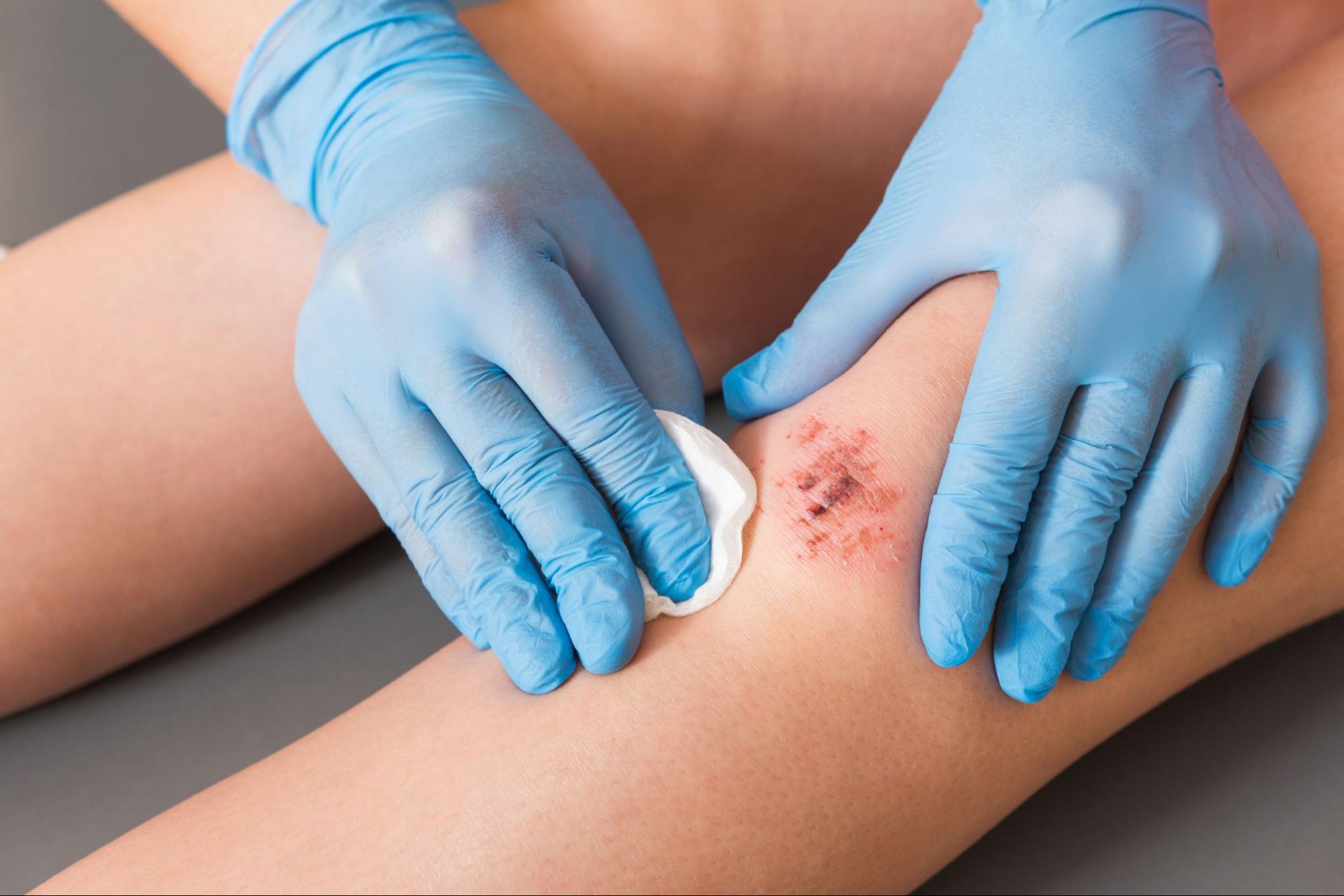 A doctor wearing blue medical gloves thoroughly cleans a patient's injured knee.